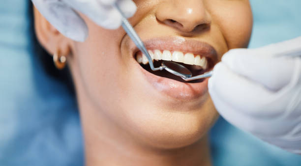 Best Chipped Tooth Repair Near Me  in Roebuck, SC